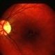central pigment epithelial changes